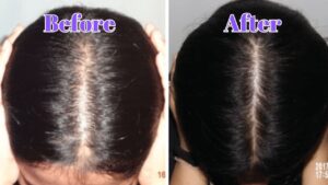 Before & After minoxidil (Rogaine)