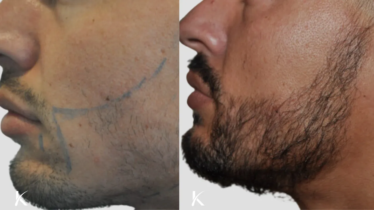 Beard Hair Transplant Before and After _ Patient 1