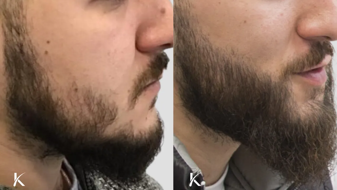 Beard Hair Transplant Before and After _ Patient 2