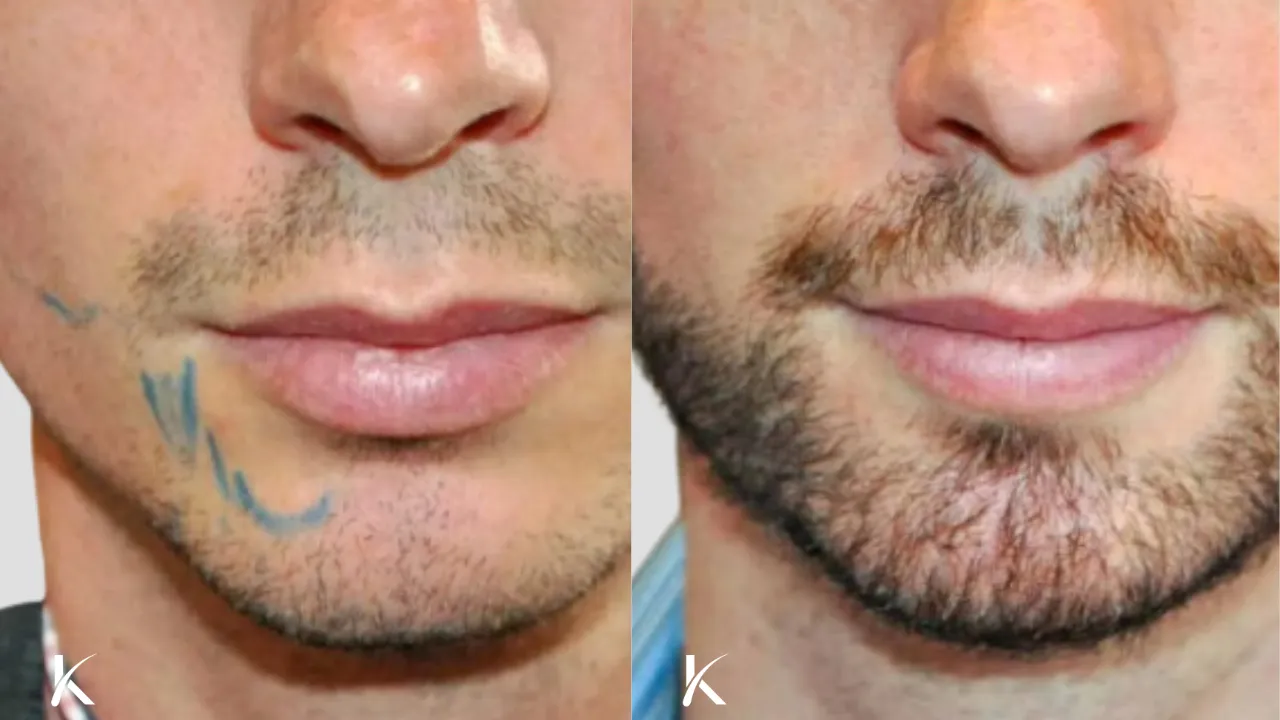 Beard Hair Transplant Before and After _ Patient 3