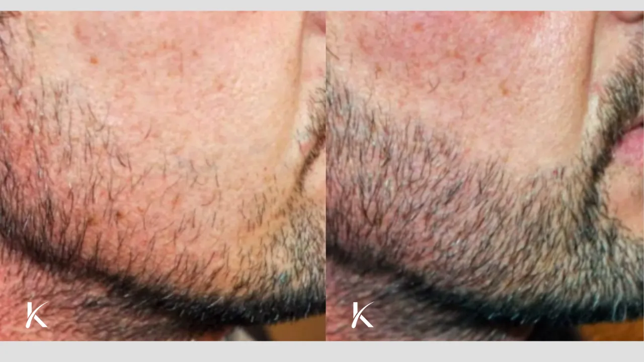 Beard Hair Transplant Before and After _ Patient 4