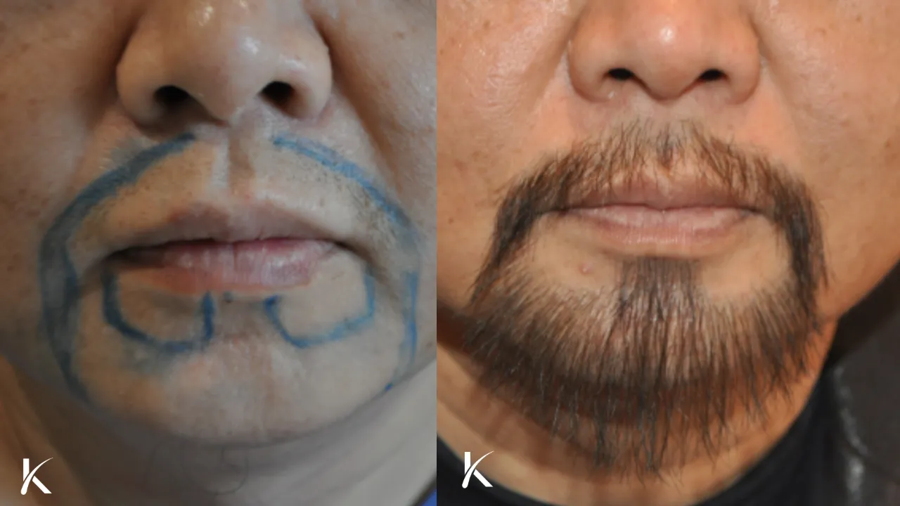 Beard Hair Transplant Before and After _ Patient 5