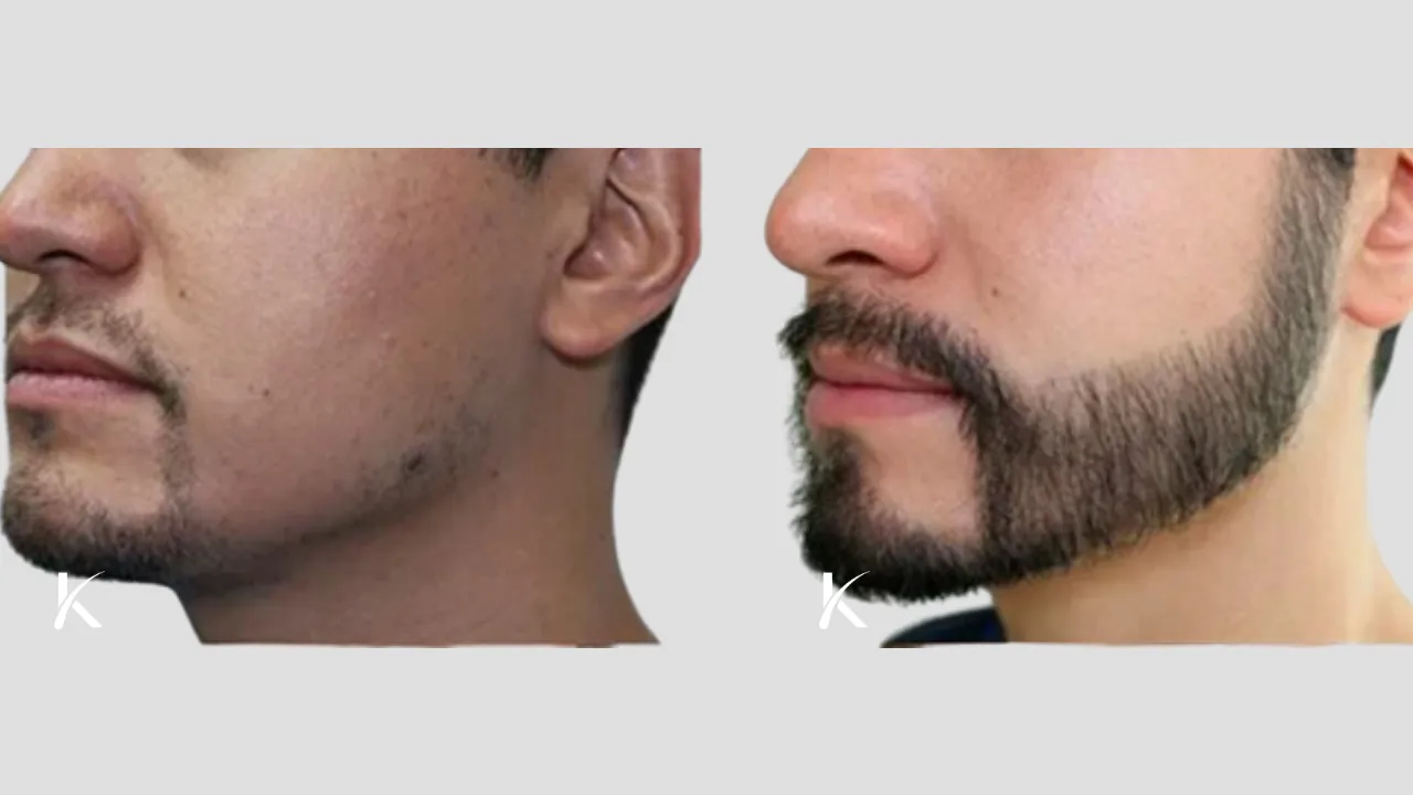 Beard Hair Transplant Before and After _ Patient 6