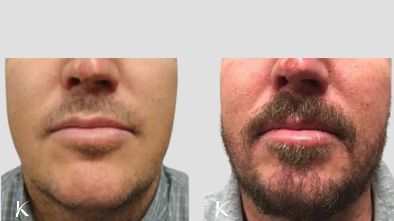 Beard Hair Transplant Before and After _ Patient 8