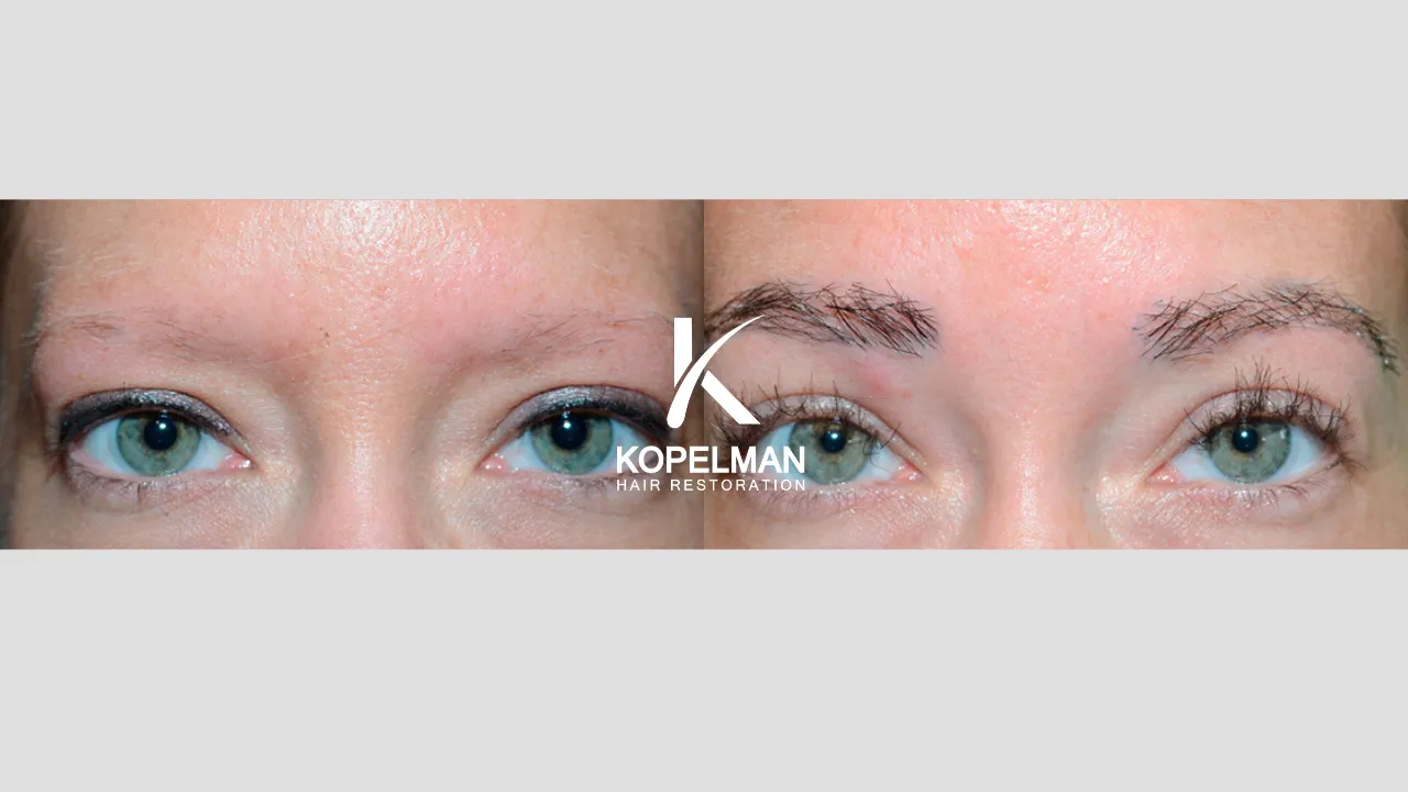 Eyebrow Hair Transplant before and after _ Patient 3