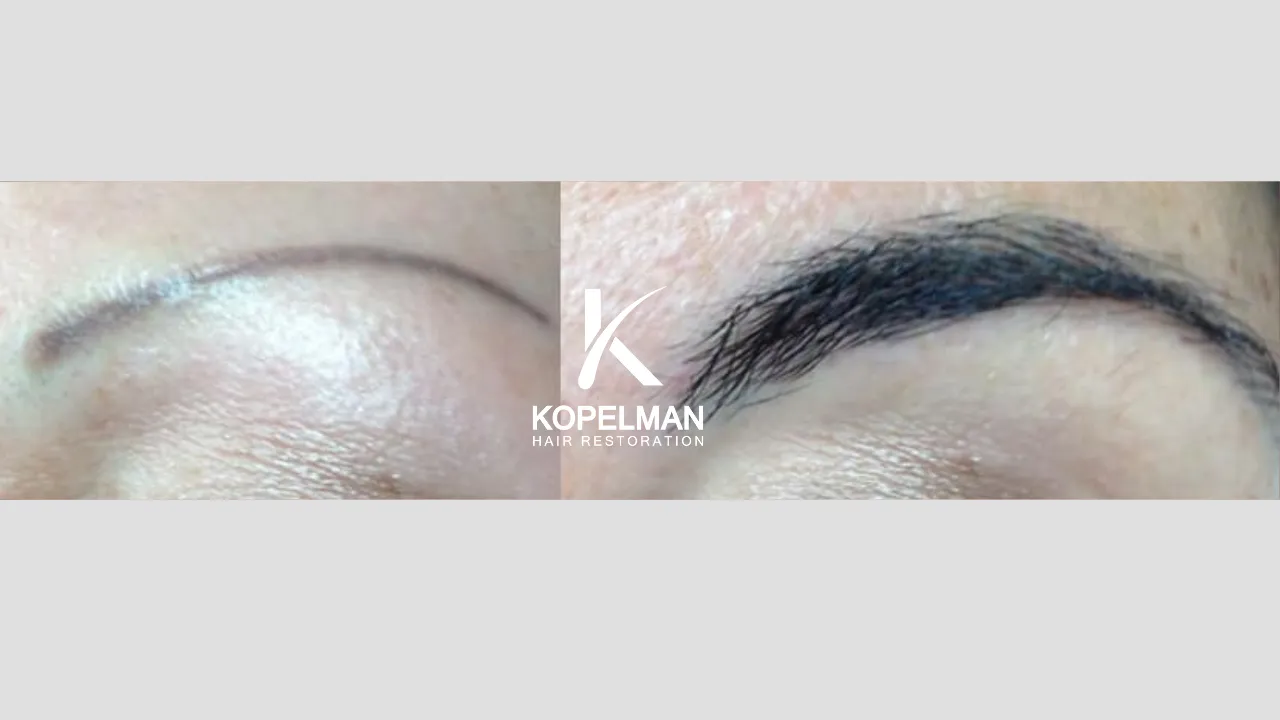 Eyebrow Hair Transplant before and after _ Patient 4