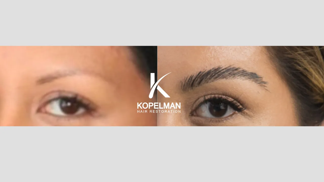Eyebrow Transplant before and after _ Patient 1 (1)