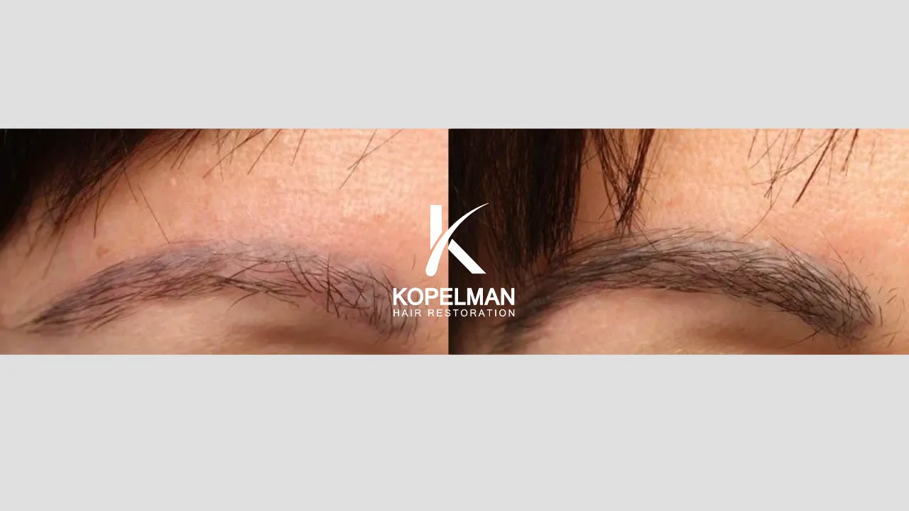 Eyebrow Transplant before and after _Patient 2