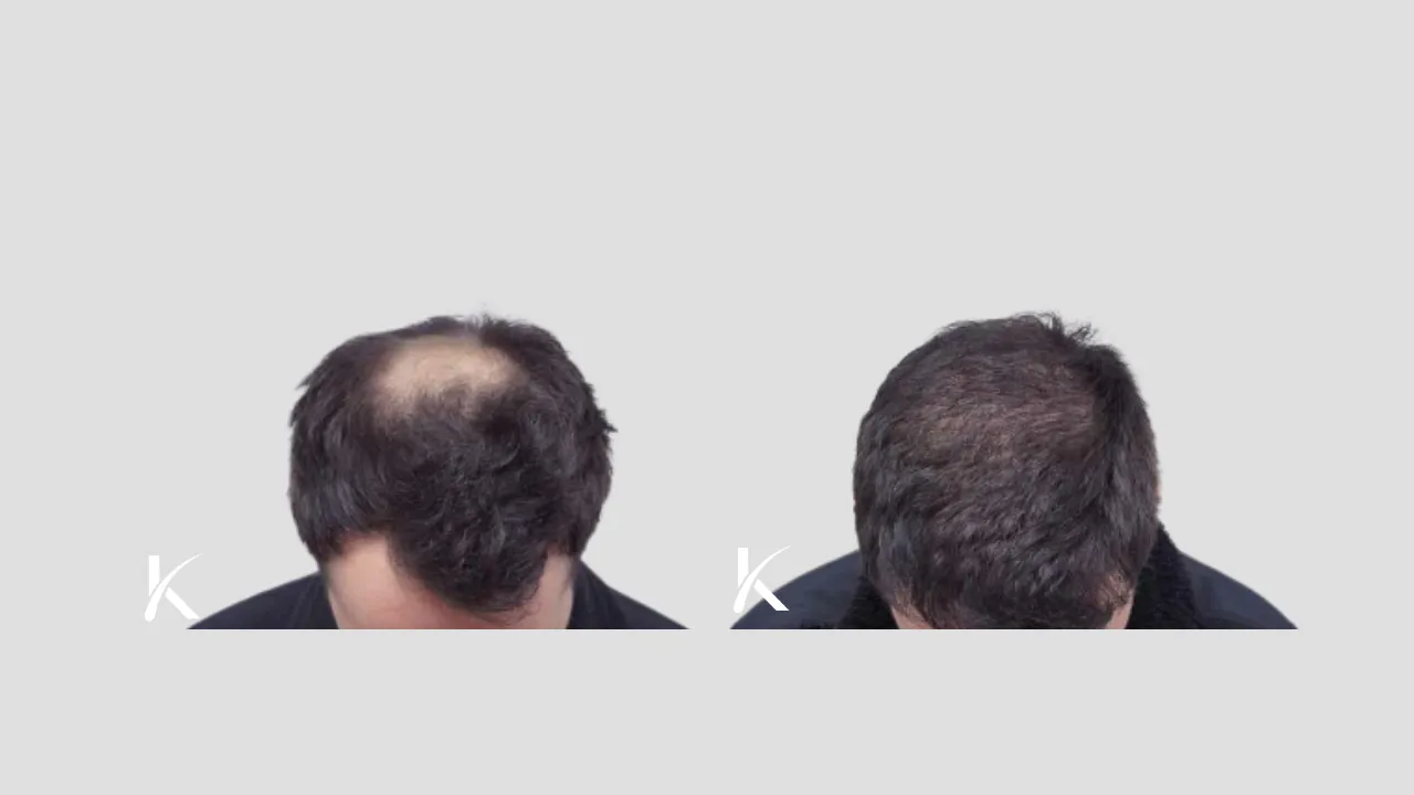 Hair Transplant Before & After Photo _ Male Patient 11