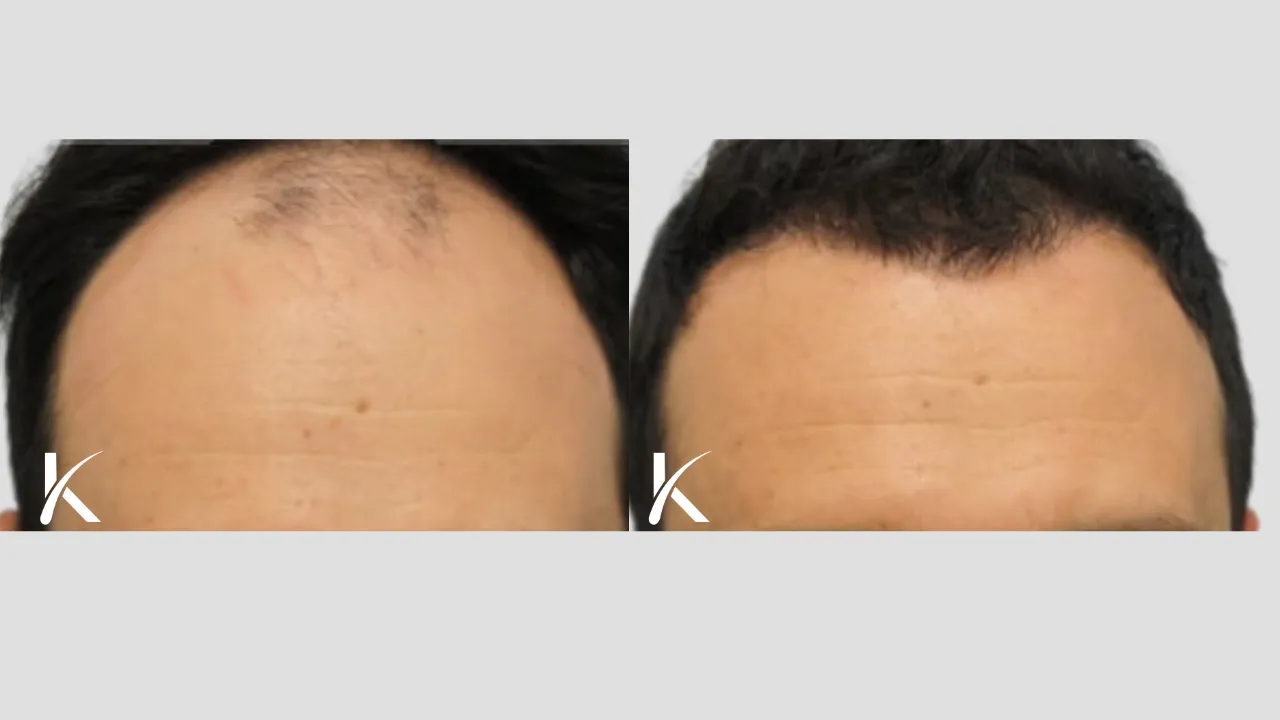 Hair Transplant Before & After Photo _ Male Patient 14