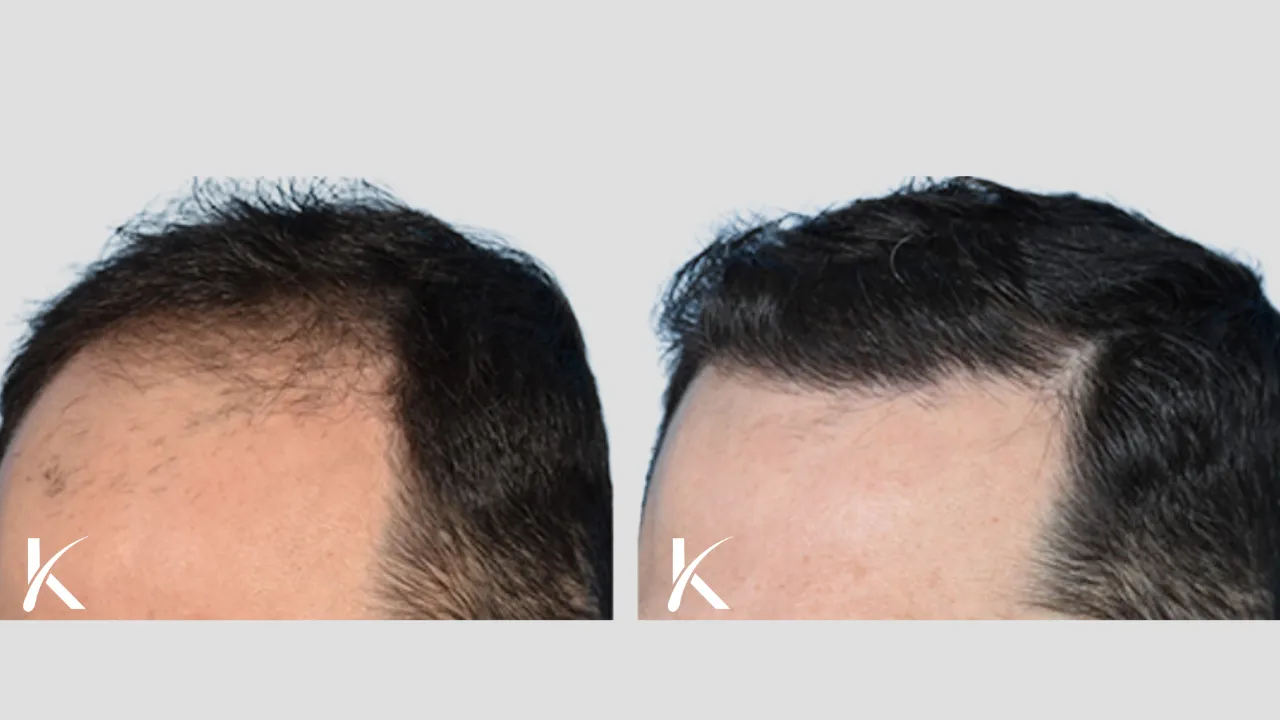 Hair Transplant Before & After Photo _ Male Patient 15
