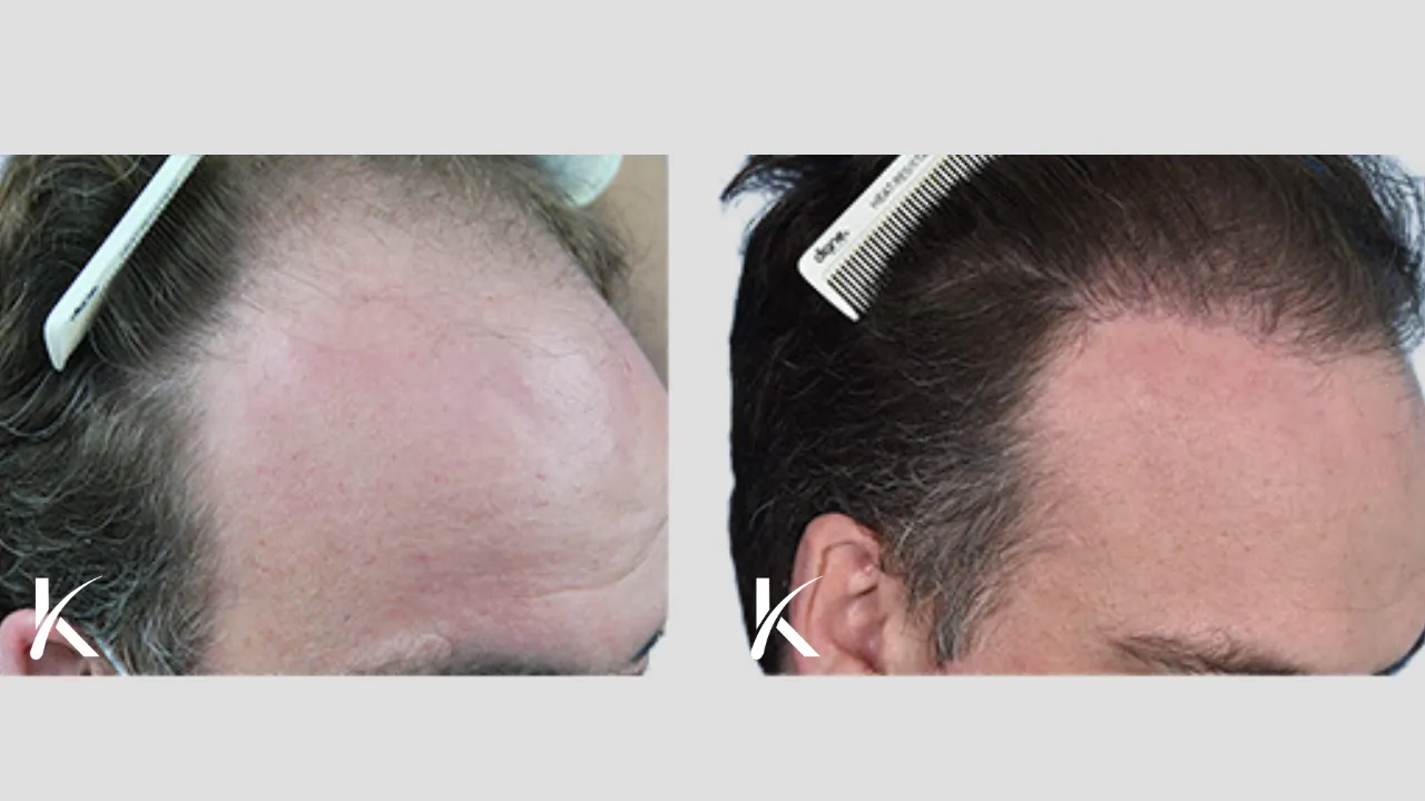 Hair Transplant Before & After Photo _ Male Patient 16