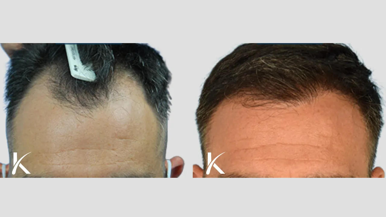 Hair Transplant Before & After Photo _ Male Patient 17