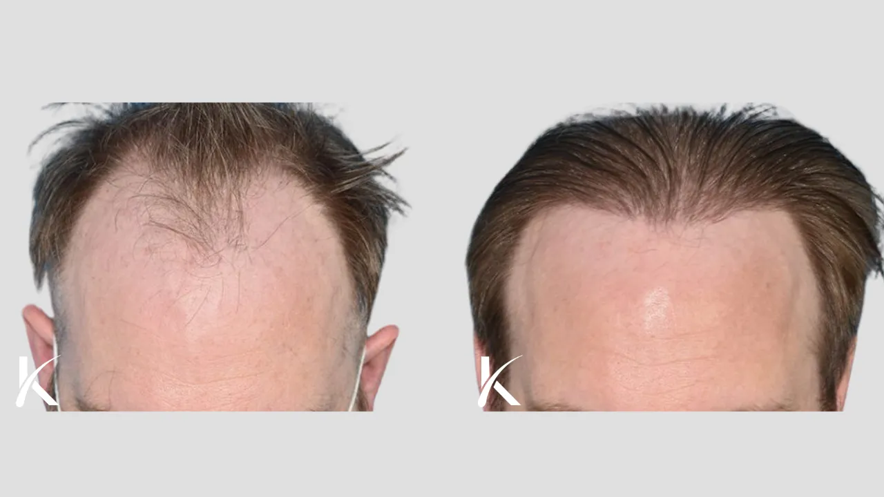Hair Transplant Before & After Photo _ Male Patient 18