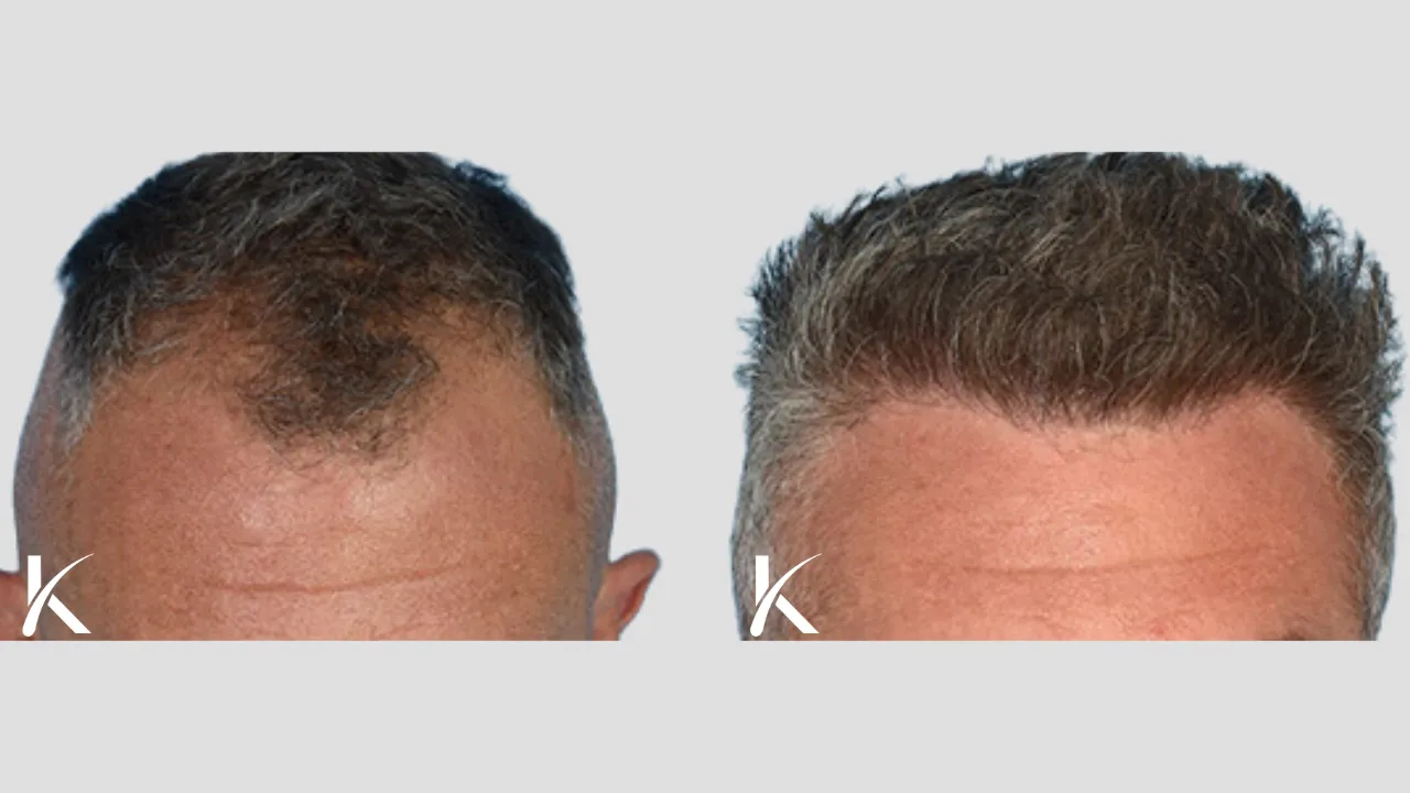 Hair Transplant Before & After Photo _ Male Patient 19
