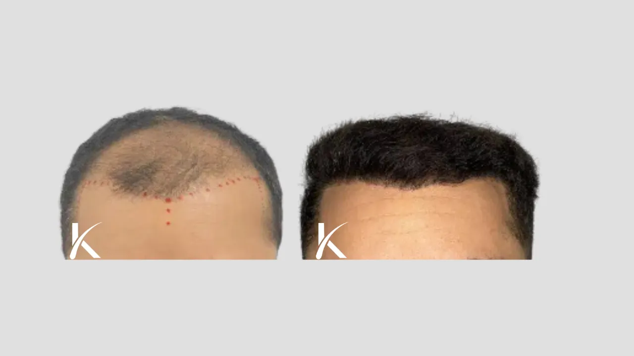 Hair Transplant Before & After Photo _ Male Patient 20