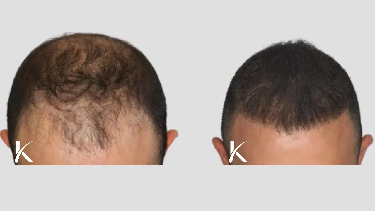 Hair Transplant Before & After Photo _ Male Patient 21