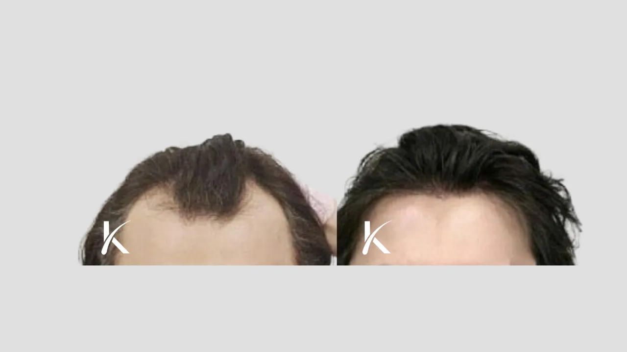 Hair Transplant Before & After Photo _ Male Patient 22