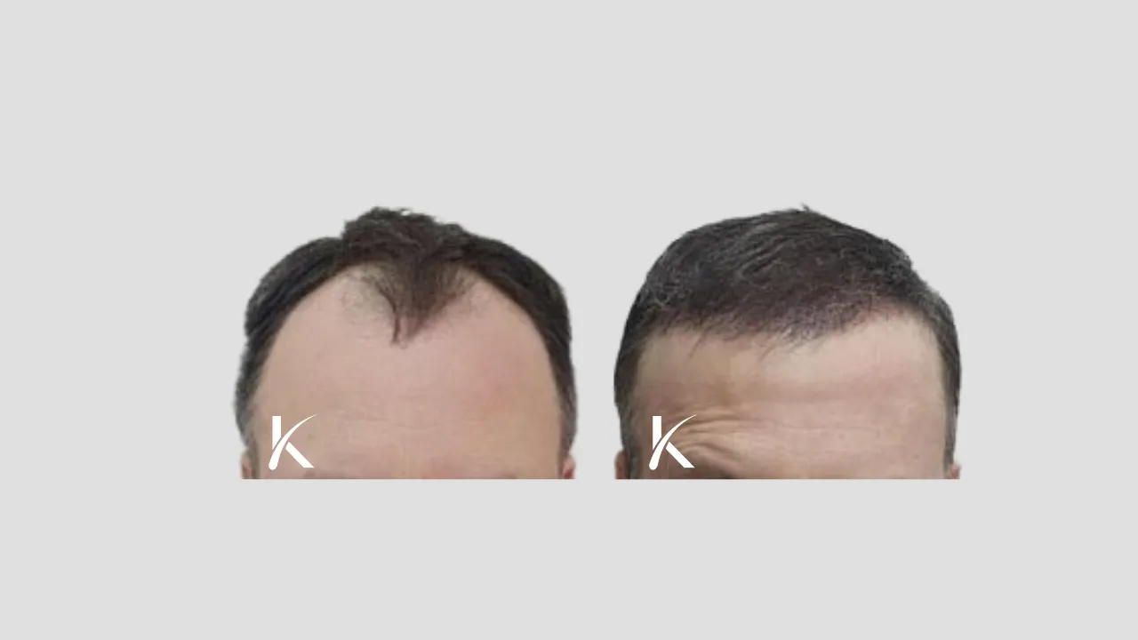 Hair Transplant Before & After Photo _ Male Patient 23
