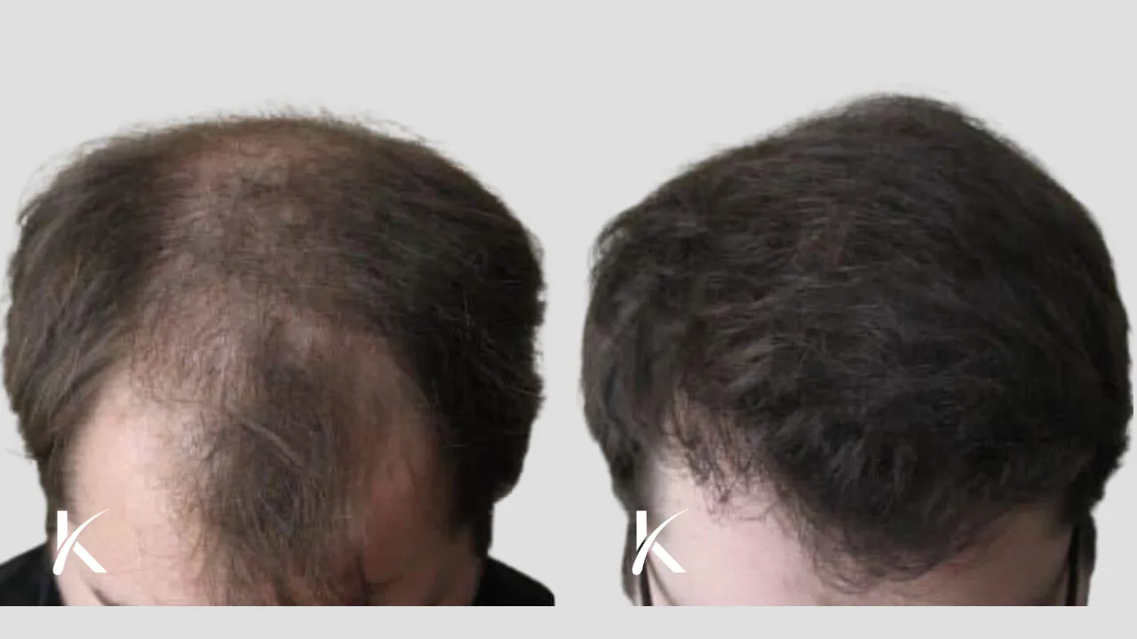 Hair Transplant Before & After Photo _ Male Patient 24