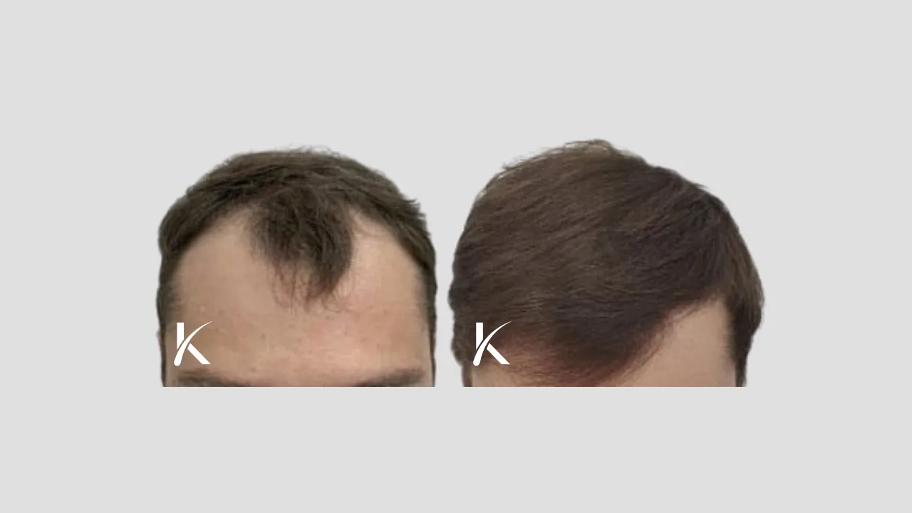 Hair Transplant Before & After Photo _ Male Patient 26