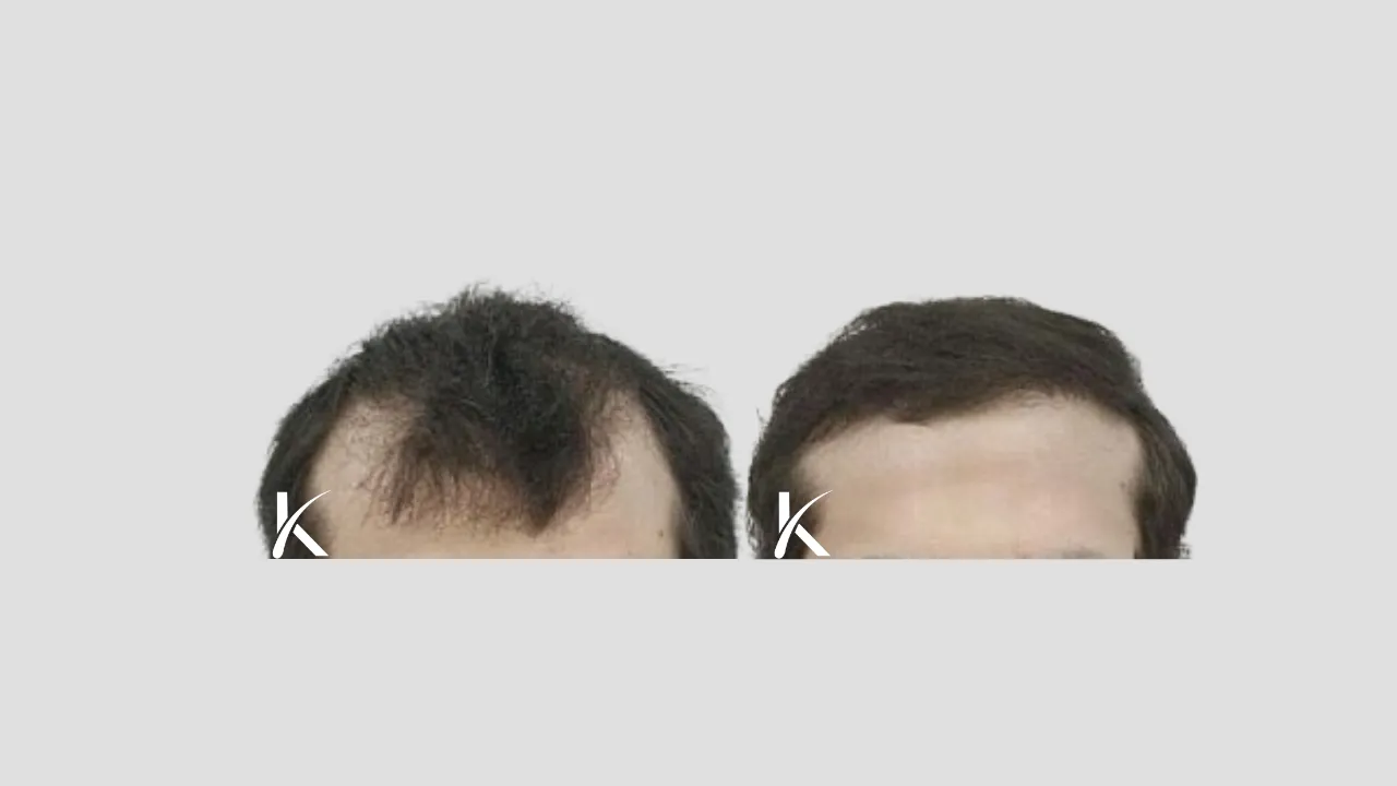 Hair Transplant Before & After Photo _ Male Patient 27