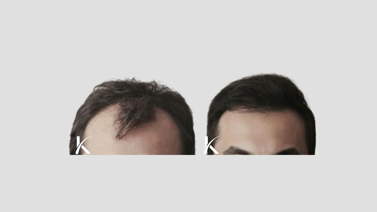 Hair Transplant Before & After Photo _ Male Patient 28