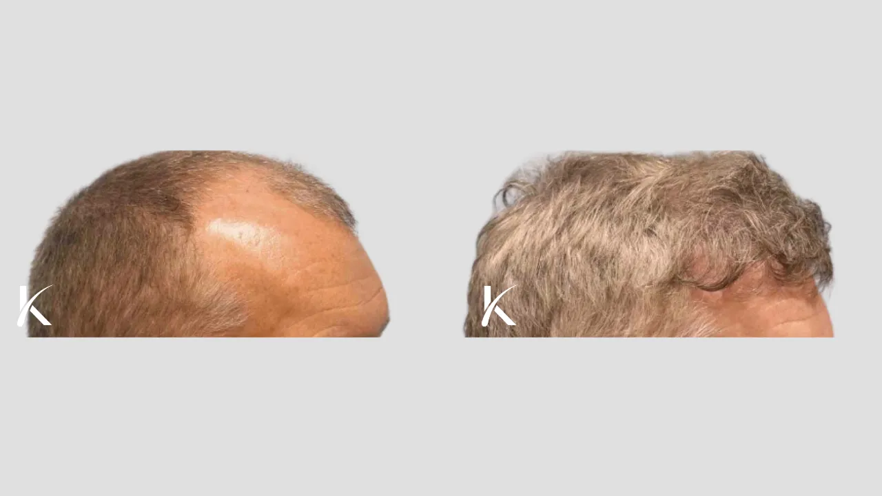 Hair Transplant Before & After Photo _ Male Patient 29