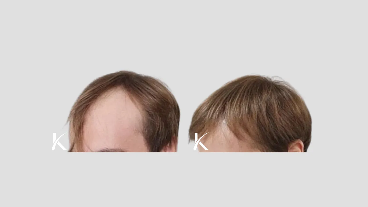 Hair Transplant Before & After Photo _ Male Patient 30