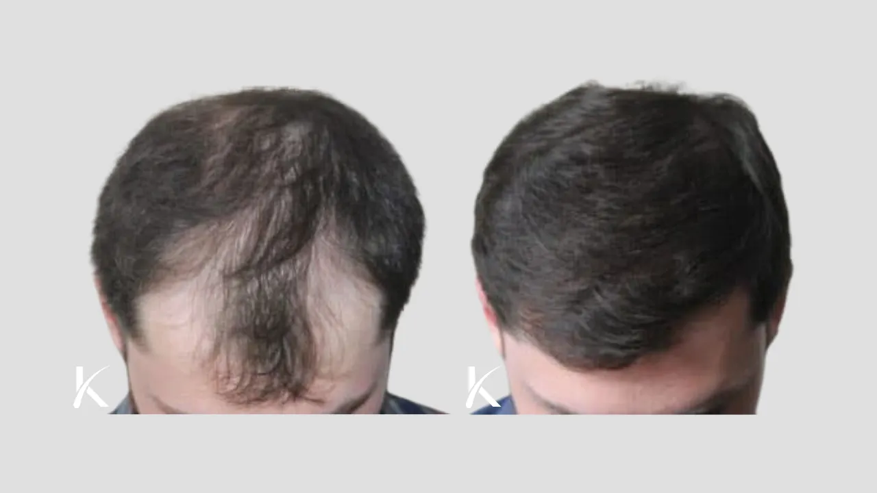 Hair Transplant Before & After Photo _ Male Patient 31