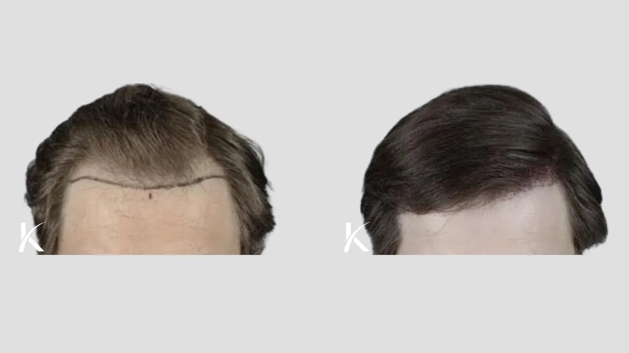 Hair Transplant Before & After Photo _ Male Patient 32
