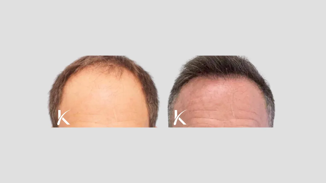 Hair Transplant Before & After Photo _ Male Patient 4