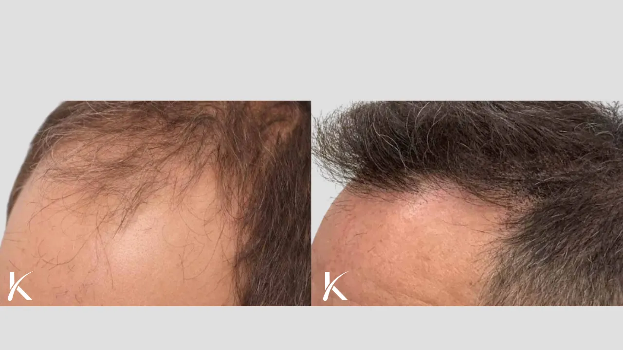 Hair Transplant Before & After Photo _ Male Patient 6