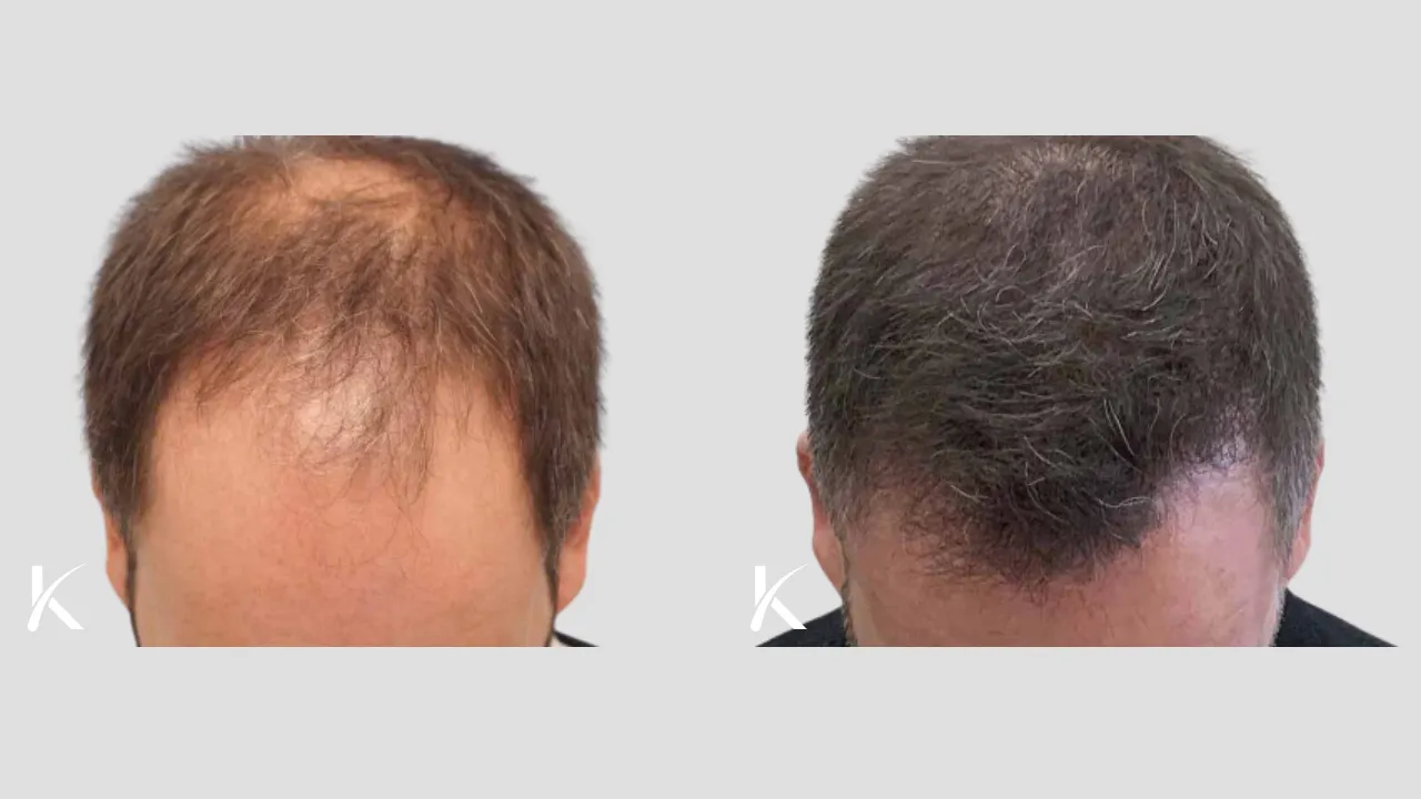 Hair Transplant Before & After Photo _ Male Patient 7