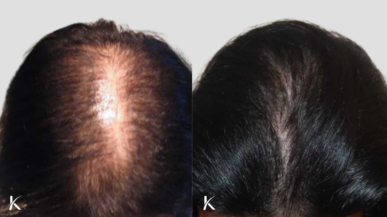 female Patient 3 - before and after hair transplant forward