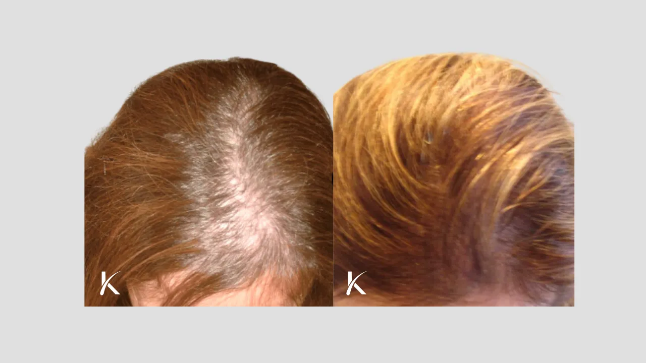 female Patient 4 - before and after hair transplant forward