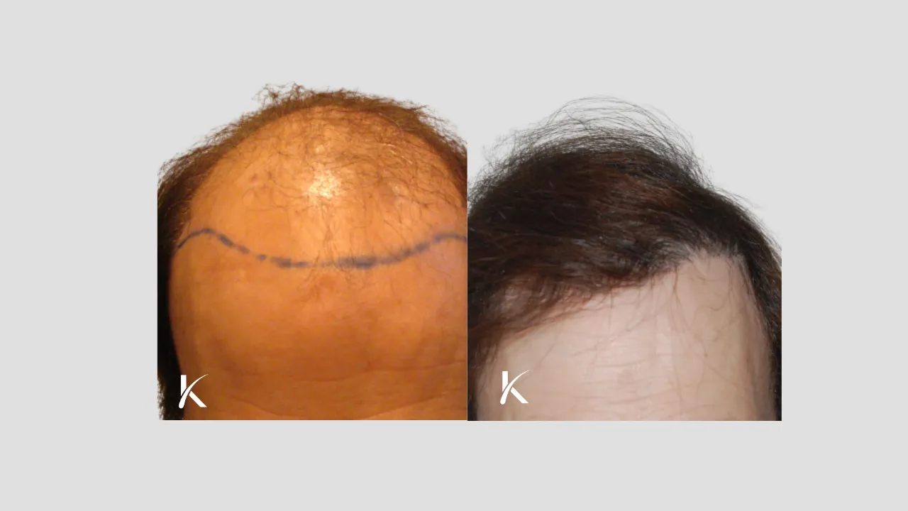 female Patient 5 - before and after hair transplant forward