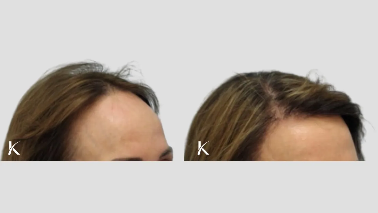 female Patient 6 - before and after hair transplant