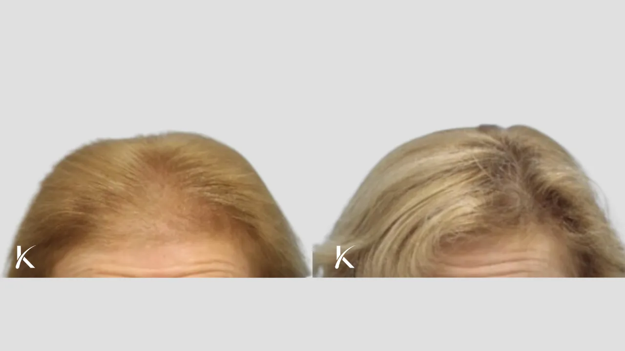 female Patient 8 - before and after hair transplant