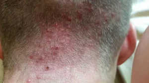 hair transplant folliculitis