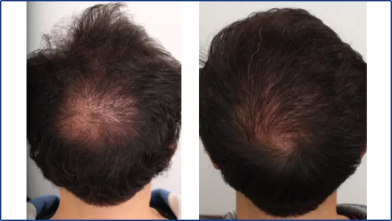 crown before and after beard hair transplant