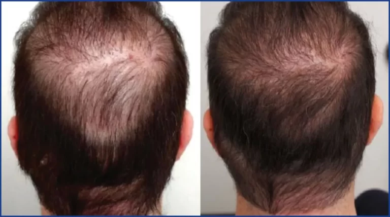 crown before and after beard hair transplant2