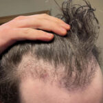 13-weeks-after-shaveless-fue3